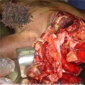 Enterococcal Infection of the Urinary Tract Causes Severe Urinary Incontinence - Decomposing Corpse Laying by the Road With It's Cranial Contents Scooped Out of It's Skull Mp3