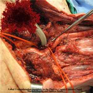 Acute Necrotizing Hepatic Tumours of the Paralyzed Liver - Failed Uvolopalatopharyngoplasty to the Pharynx Causes Extensive Nasal Haemorrhaging and Sudden Death Mp3